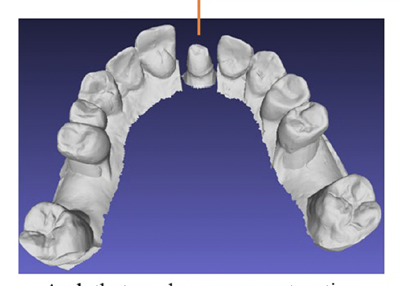 dental-crown-restoration-AI